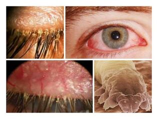 sintomas da presença de parasitas sob a pele humana